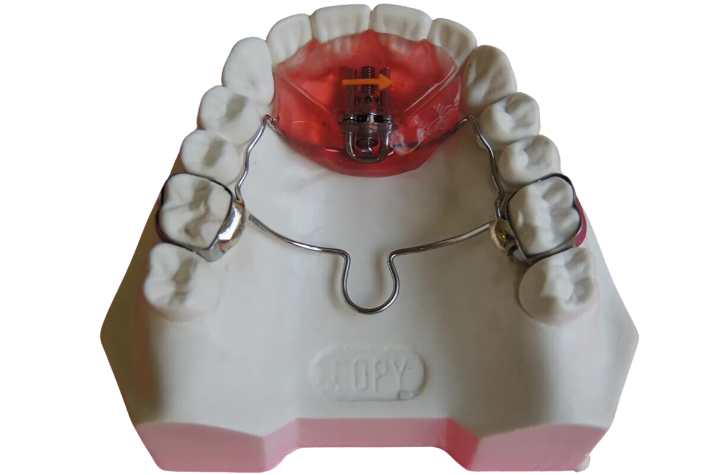 Botón de Nance Sr. Lab Dental