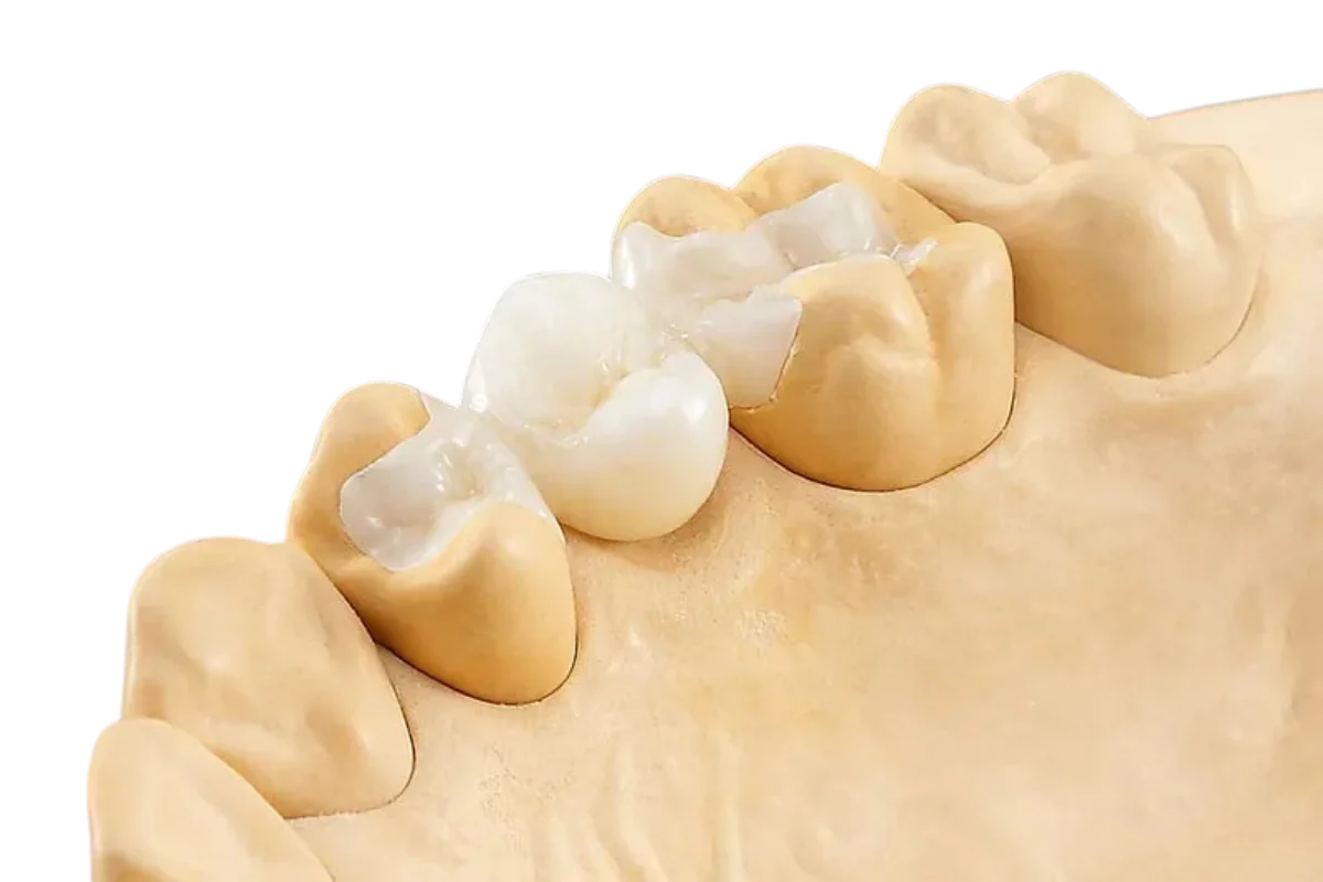 CORONA DE ZIRCONIO FRESADO CAD_CAM(1)