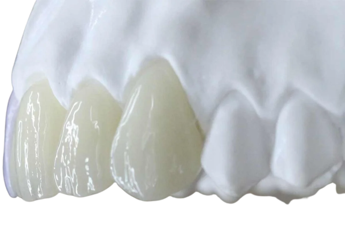 CORONA DISILICATO DE LITIO FRESADO CAD_CAM