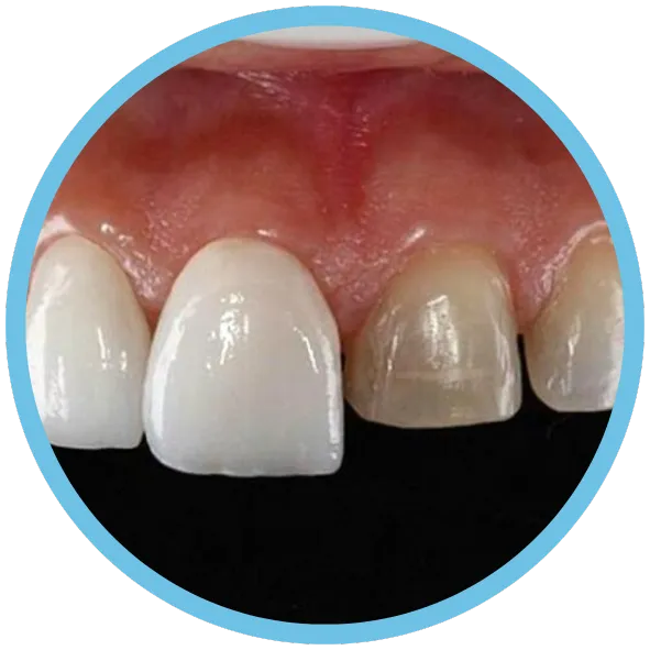 Carilla de Zirconio Fresado CAD_CAM