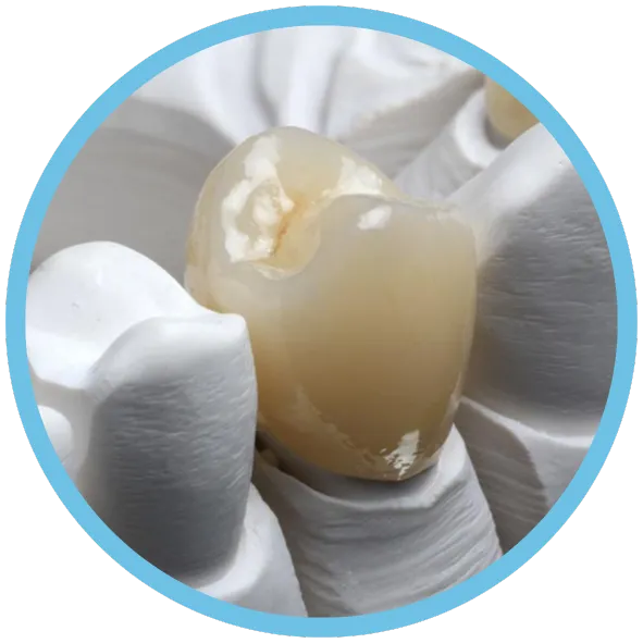 Corona de Zirconio Fresado CAD_CAM
