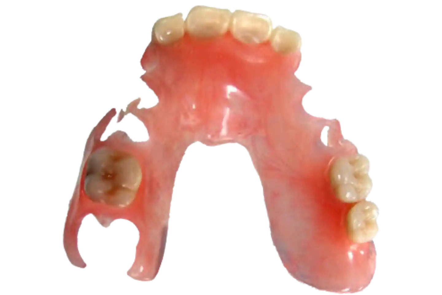 Prótesis Parcial Flex de 1 a 6 Piezas(1)
