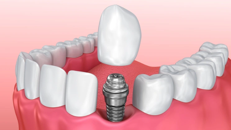 Corona sobre Implantes de Zirconio Fresado CADCAM