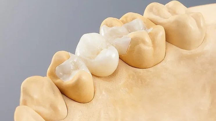 Incrustación de Zirconio Fresado CADCAM